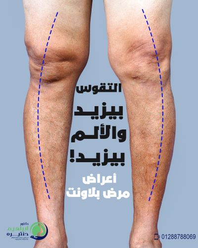 علاج تقوس الساقين للكبار